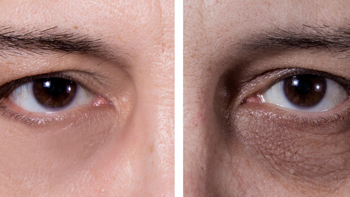 dark circles around eyes caused by lack of sleep