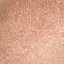 image of dry skin