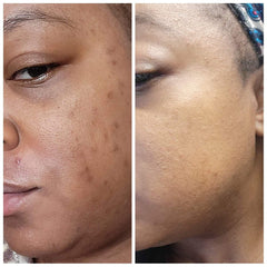 Noraa Body Love skin before and after picture