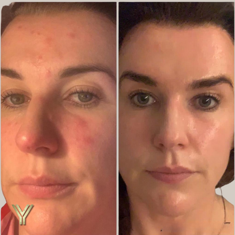 acne results from TriBella