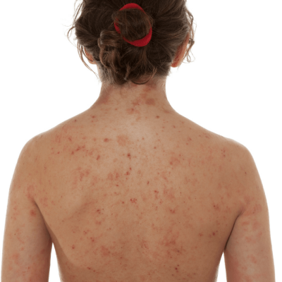 contact dermatitis blog post