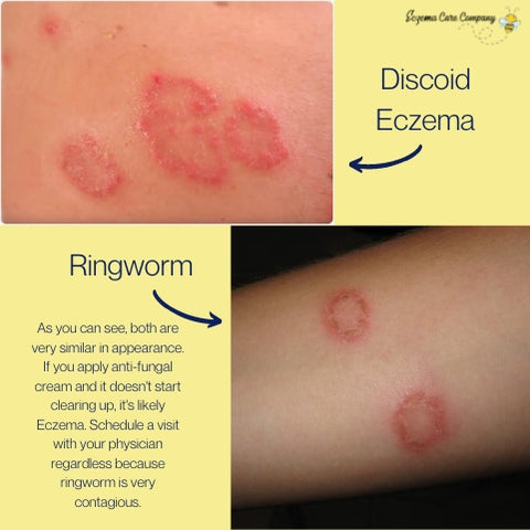 discoid-eczema-vs-ringworm