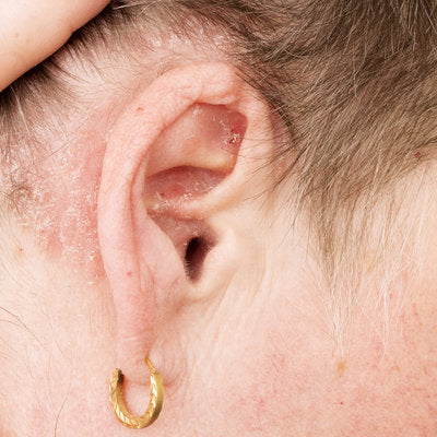 ear-eczema-what-to-know