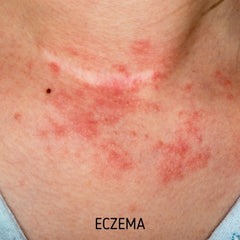 eczema-appearance-vs-psoriasis