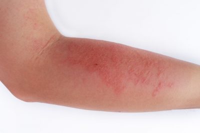 atopic-dermatitis-the-eczema-soap