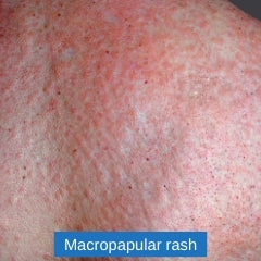 macropapular-rash-covid-19-skin-symptom