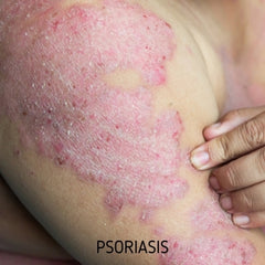 psoriasis-appearance-eczema-care-company