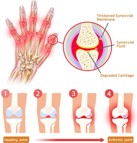 ThermoCare™ Bee Venom Joint and Bone Therapy Patch