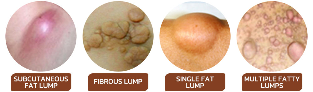 GFOUK™ Lumpless Lipoma Treatment Cream