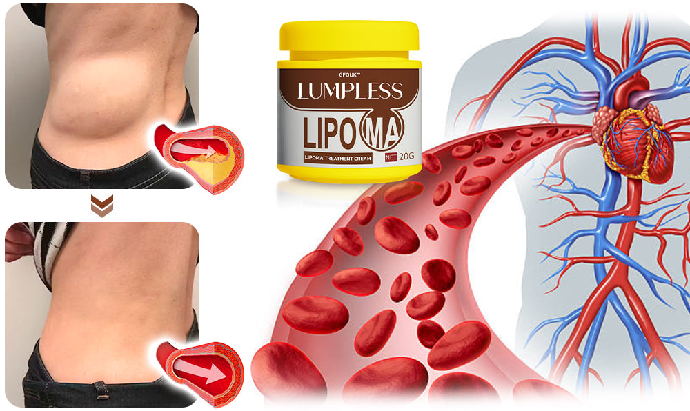 GFOUK™ Lumpless Lipom-Behandlungscreme