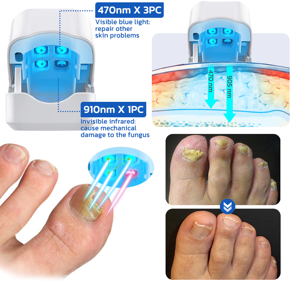 Toenail Fungus Laser Treatment most effective for unsightly toenails.