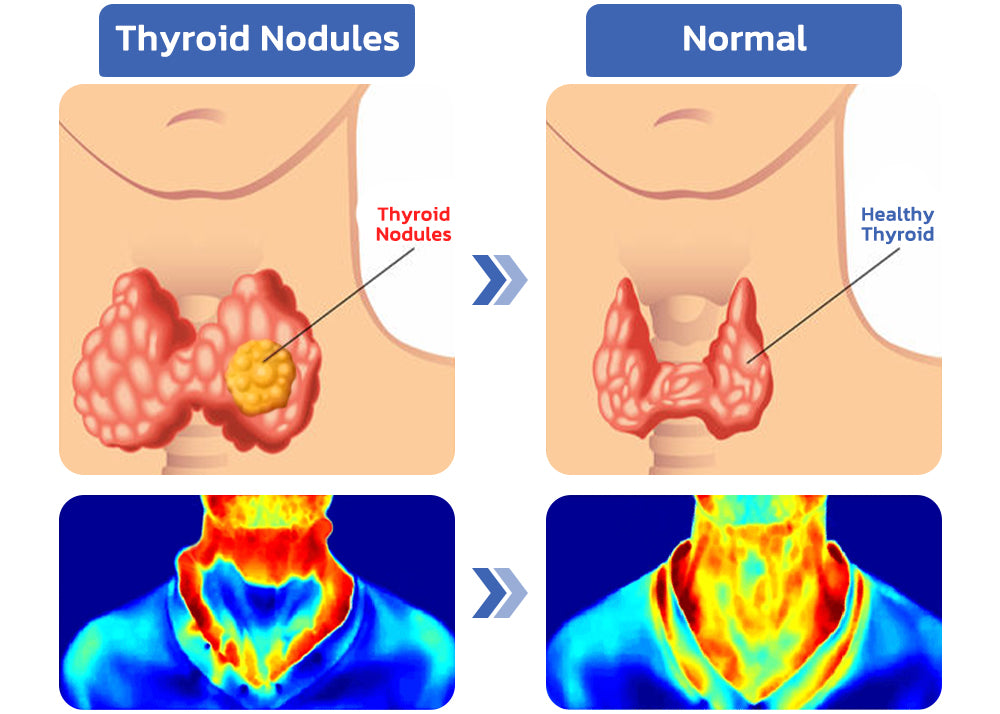 GFOUK™ ThyroidCare Anti-Schwellung Lymphatische Reinigungsrolle