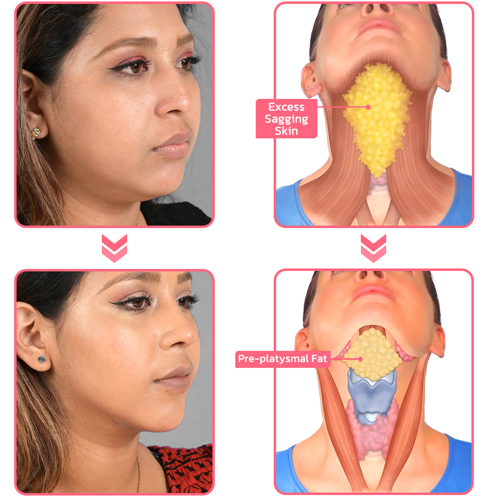 flysmus™ V Face Suction Beauty Trainer