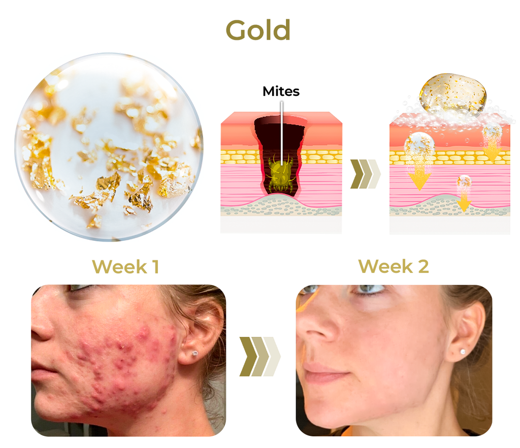 Humxf™ AcneVe Anti-Mite Gold Foil Soap