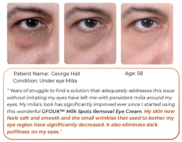 GFOUK™ Milk Spots Removal Eye Cream
