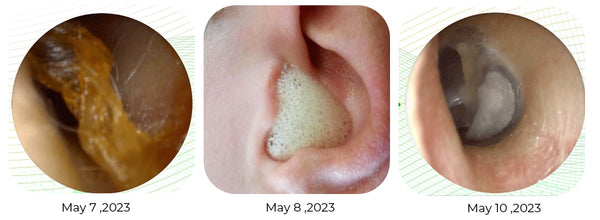 GFOUK™ Anti Tinnitus Earwax Removal Spray 