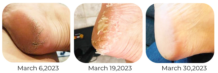 Aghanim Foot Callus Removal Spray - KlariME Foot Peeling Spray, Anti Foot  Callus Removal Spray, Foot Heel Callus Remover Spray, Foot Peeling Spray  Orange Oil, Removes Callus & Cracked Heels (3) - Yahoo Shopping