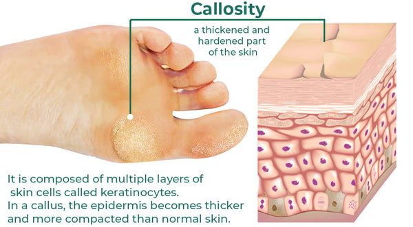 Aghanim Foot Callus Removal Spray - KlariME Foot Peeling Spray