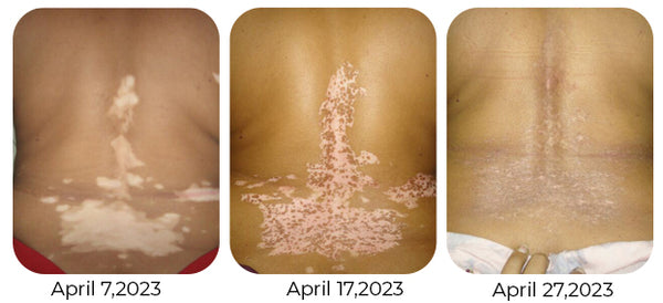 GFOUK™ Vitiligo Therapy Cream