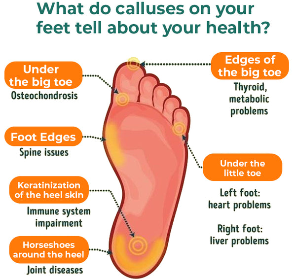 How do I get rid of these foot calluses? I hate how they've turned my foot  yellow :( : r/beauty