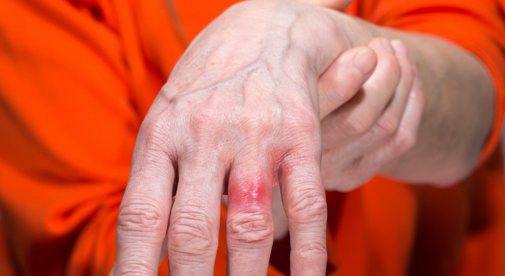 Allergic reaction on ring finger