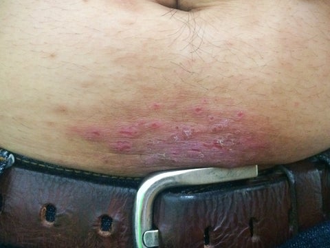 Metal allergy on stomach