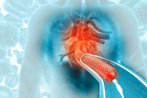 Illustration of a cardiac stent