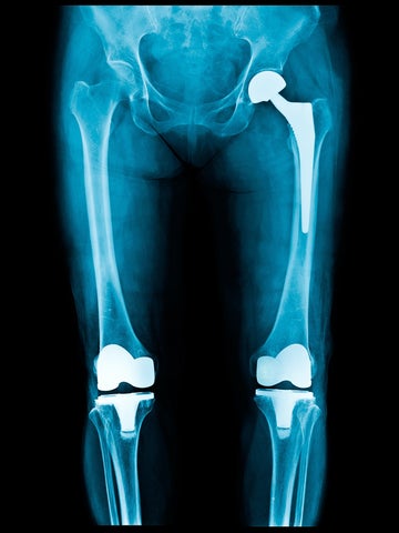 X-ray showing hip and knee implants