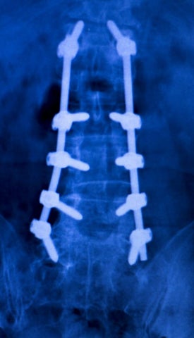 X-ray of injured back