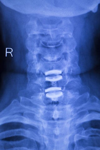 X-ray of injured neck