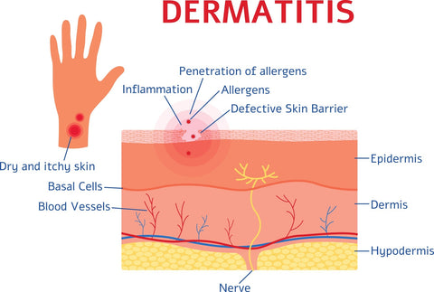 Dermatitus diagram