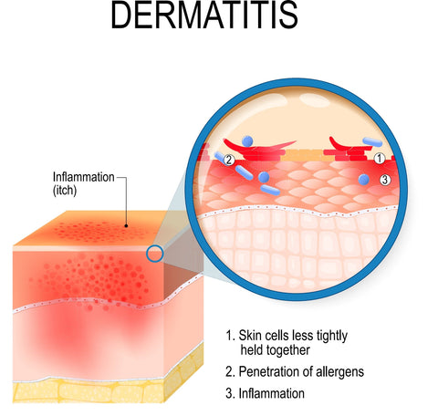 Diagram showing dermatitis