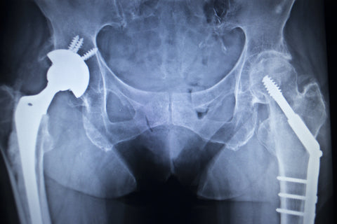 X-ray showing metal implants