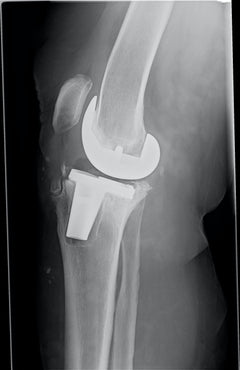 K-ray showing implant loosening