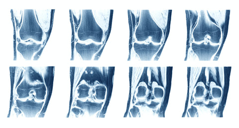X-ray showing joint effusion