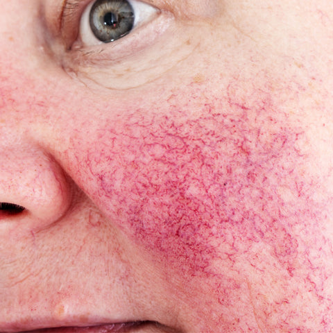 A bad case of rosacea