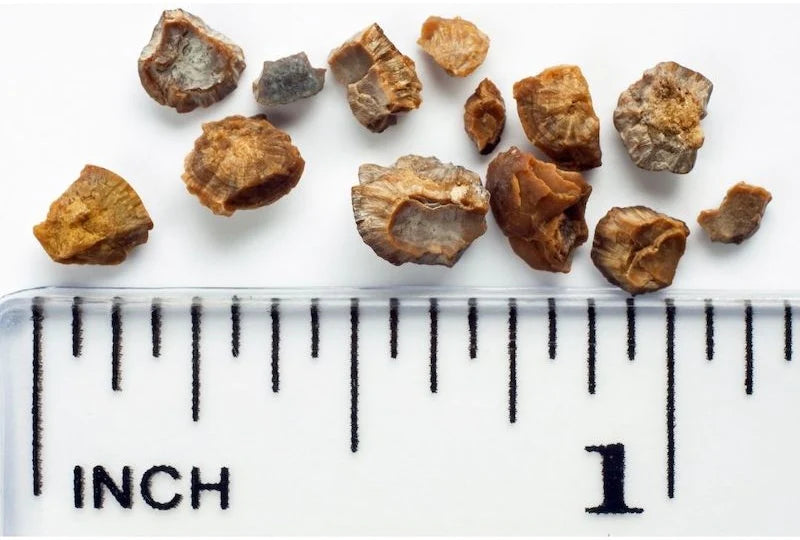 example of kidney stone measured