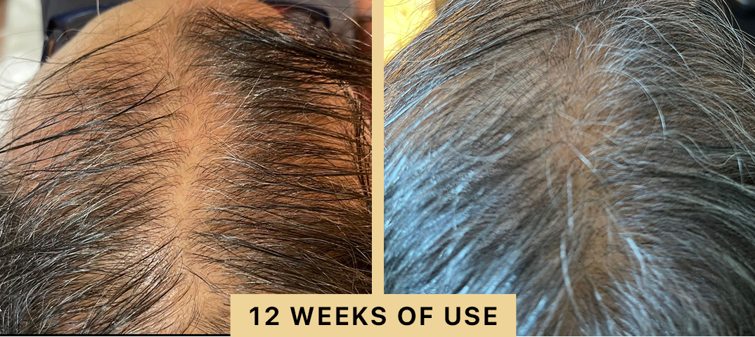 Back2Life Groluxe Advanced Hair Stimulation Oil Before & After Results 12 Weeks of Use