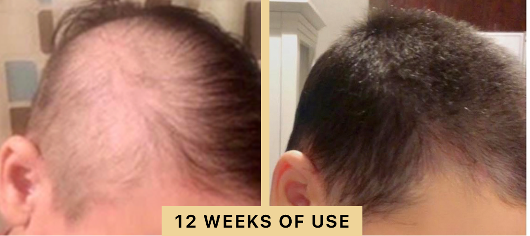 Back2Life Groluxe Advanced Hair Stimulation Oil Before & After Results 12 Weeks of Use