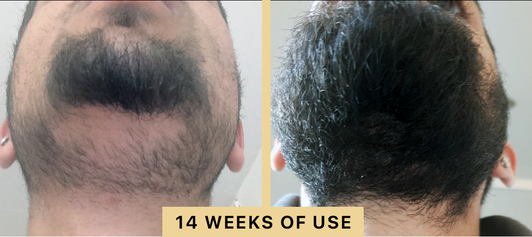 Back2Life Groluxe Advanced Hair Stimulation Oil Before & After Results 14 Weeks of Use