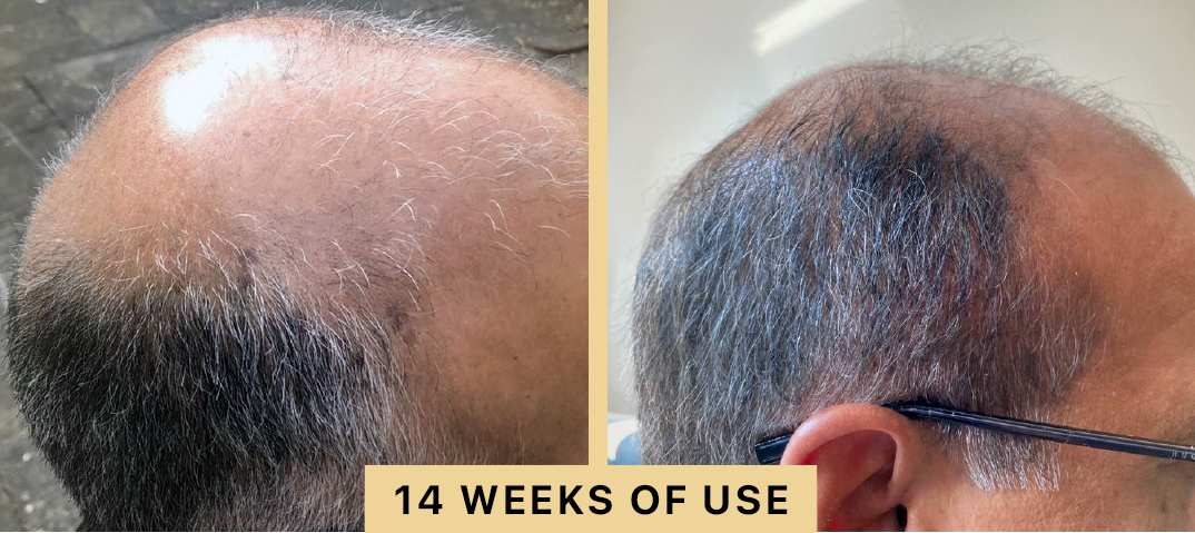 Back2Life Groluxe Advanced Hair Stimulation Oil Before & After Results 14 Weeks of Use