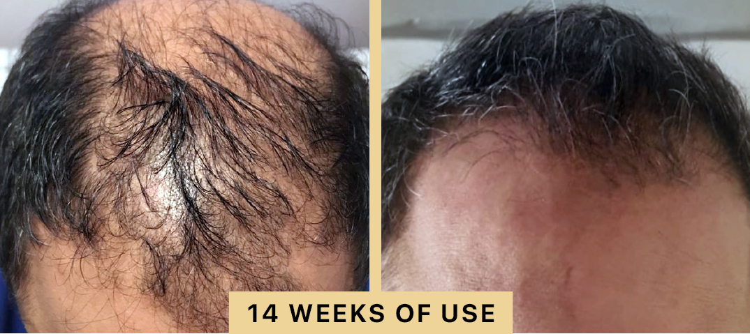 Back2Life Groluxe Advanced Hair Stimulation Oil Before & After Results 14 Weeks of Use