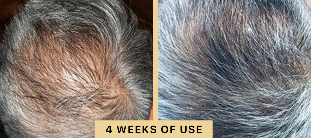 Back2Life Groluxe Advanced Hair Stimulation Oil Before & After Results 4 Weeks of Use