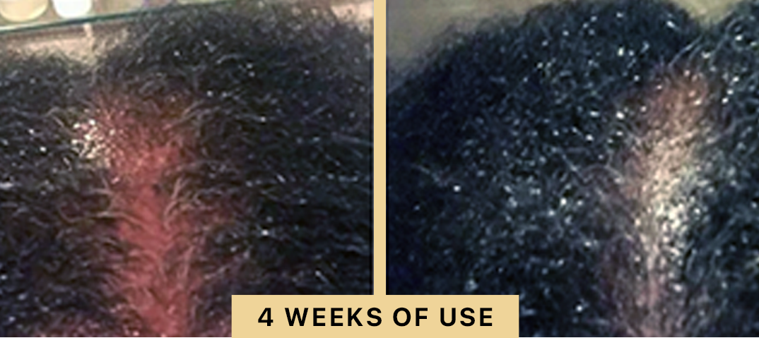 Back2Life Groluxe Advanced Hair Stimulation Oil Before & After Results 4 Weeks of Use