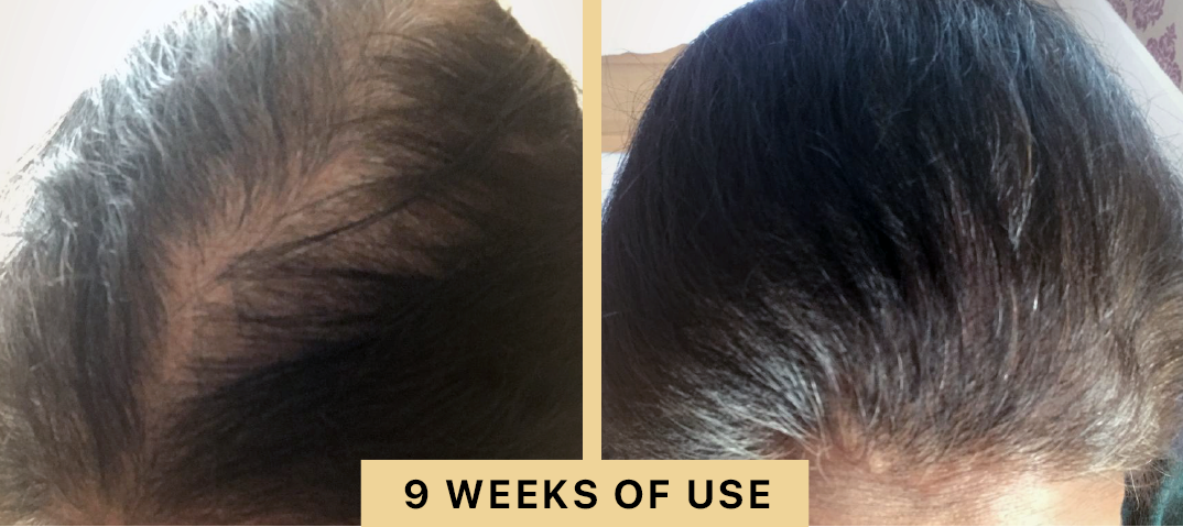 Back2Life Groluxe Advanced Hair Stimulation Oil Before & After Results 9 Weeks Of Use