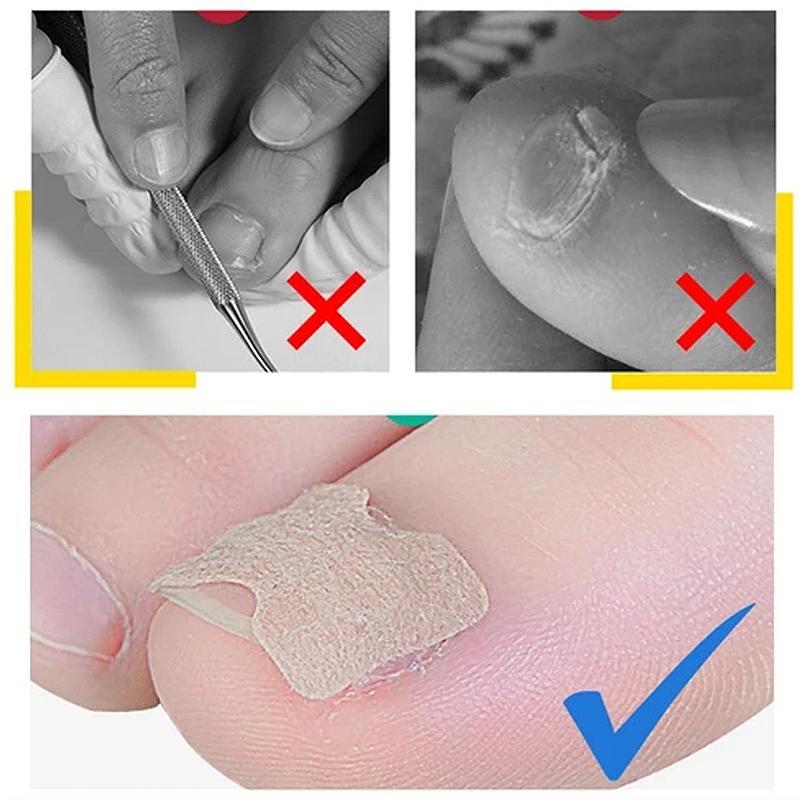 Non-Glue Toenail Patch