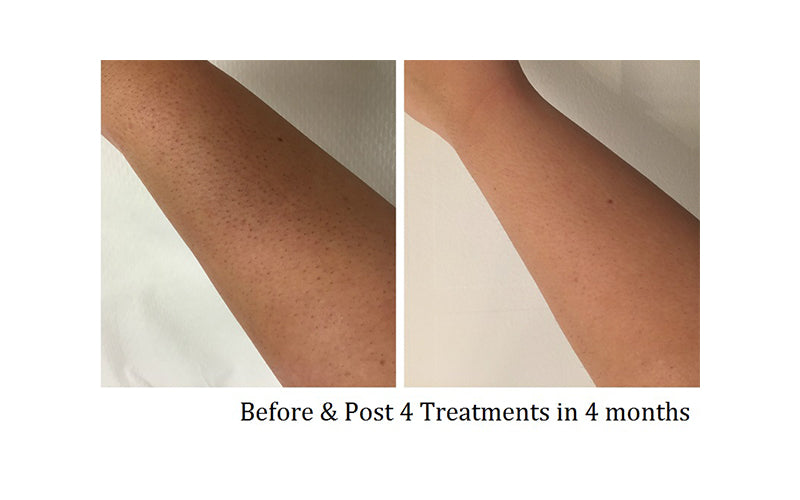 hair removal before and after of arm