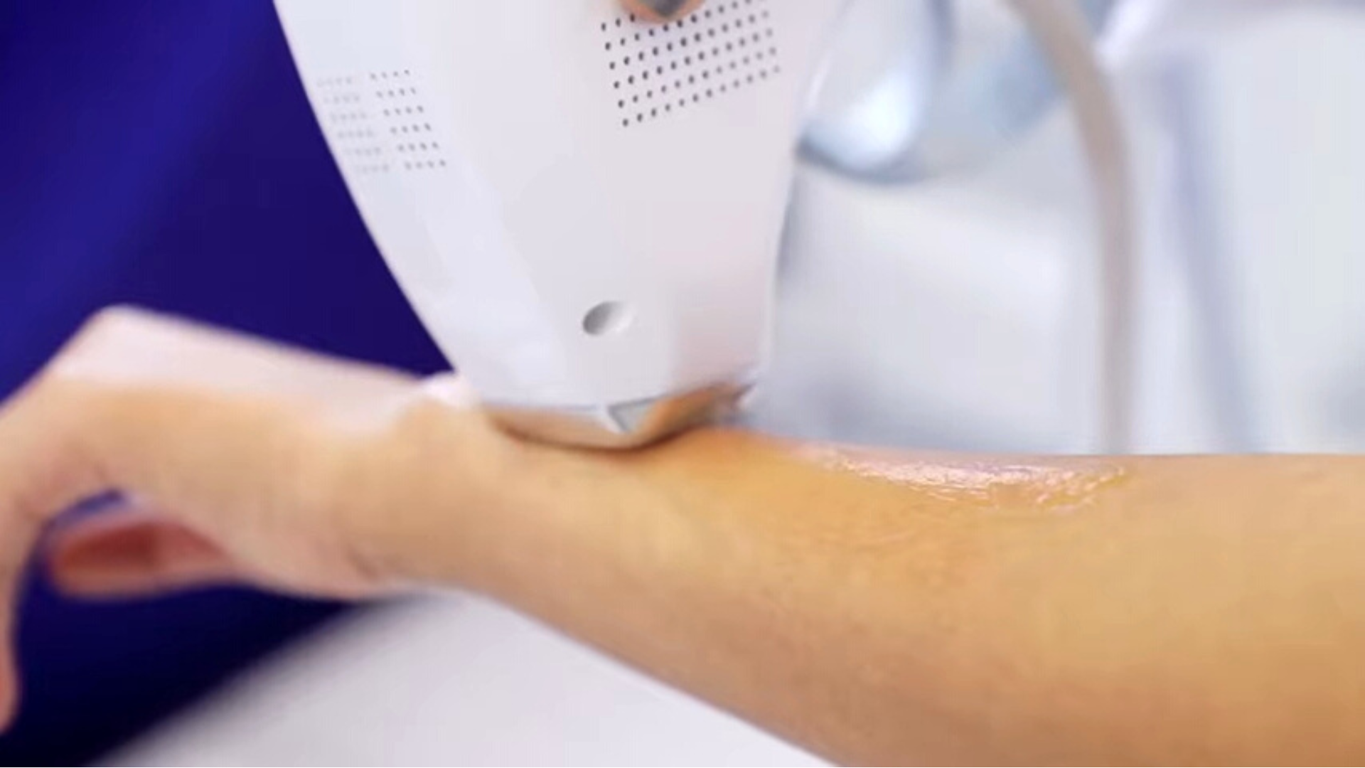diode laser tech in hair removal