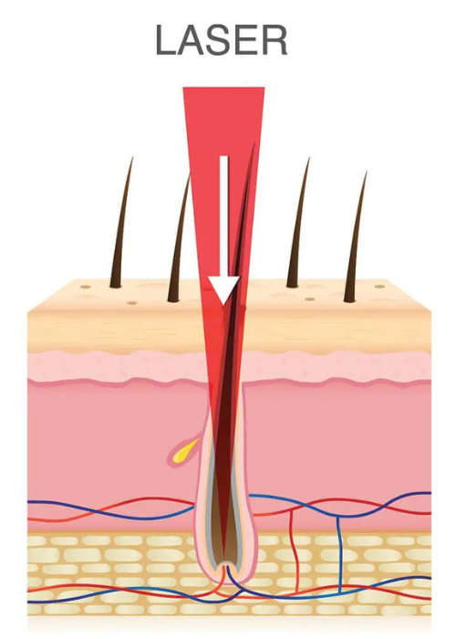 Diode Laser Hair Removal VS. IPL Hair Removal - Spotless Laser