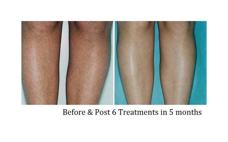 hair removal before and after of leg